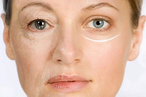 Cach Xoa Nep Nhan Hieu Qua Chuan Y Khoa – Bi Quyet Tre Hoa Da 2