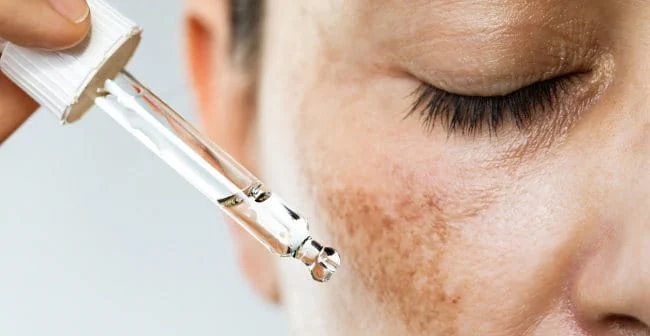 [Review] Các Tips Trị Nám Nhanh Chóng Mà Chị Em Không Thể Bỏ Lỡ Trong Mùa Hè Này (2)