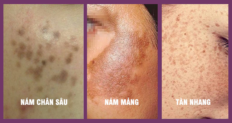 [Review] Cách Trị Nám, Tàn Nhang Hiệu Quả Mà Bạn Không Thể Bỏ Lỡ