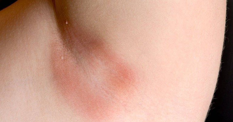 Tay Long Nach Bi Rat Co Sao Khong 6 Cach Khac Phuc Hieu Qua Tu LiA Spa Beauty 2