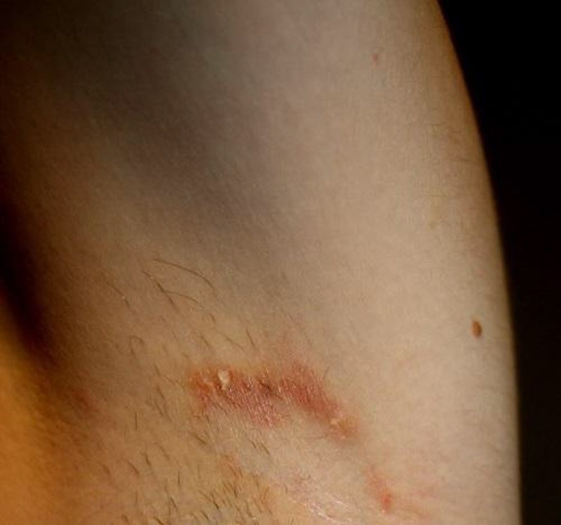 Tay Long Nach Bi Rat Co Sao Khong 6 Cach Khac Phuc Hieu Qua Tu LiA Spa Beauty 3