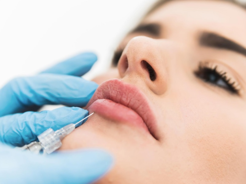 Tiêm Filler Môi – Giải Pháp Hoàn Hảo Cho Đôi Môi Căng Mọng, Tự Nhiên (1)