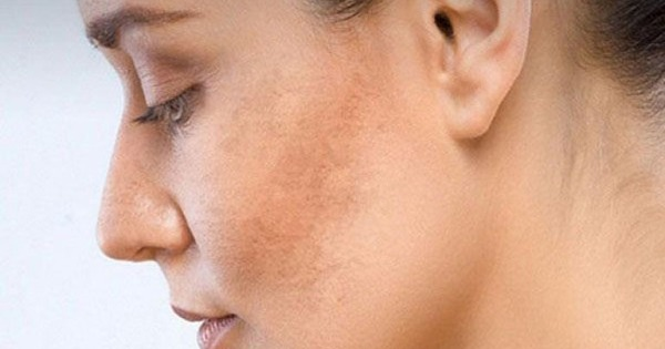 5 Cách Trị Sạm Da Tự Nhiên Tại Nhà Hiệu Quả – Dễ Làm & An Toàn (1)