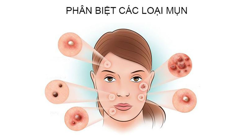 Cách Nhận Biết Các Loại Mụn Và Phương Pháp Khắc Phục Hiệu Quả – Gợi Ý Từ LiA Spa (2)