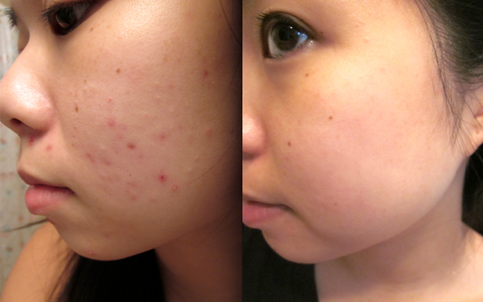 Chăm Sóc Da Bị Thâm Mụn Hiệu Quả Tại Nhà – Hướng Dẫn Đơn Giản Từ LiA Spa (2)