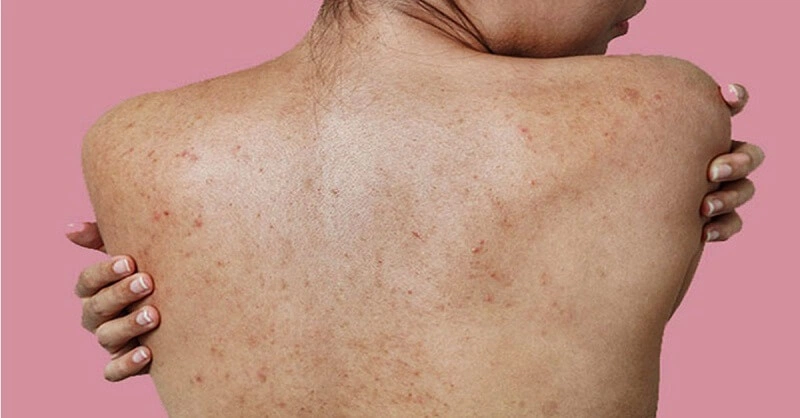 Mụn Lưng Nguyên Nhân, Dấu Hiệu Và Cách Điều Trị Hiệu Quả (1)