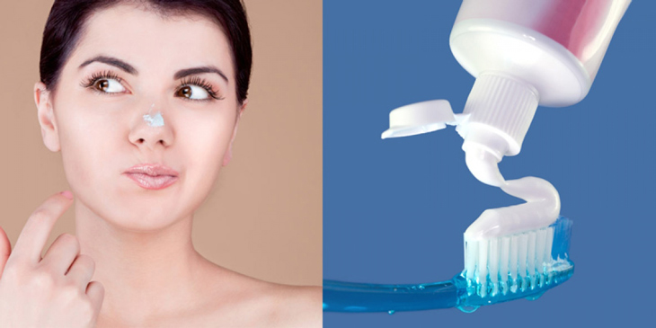 Trị Mụn Bằng Kem Đánh Răng Có Thật Sự Hiệu Quả Sự Thật Bạn Cần Biết